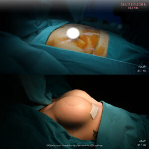 เสริมหน้าอกซัน เสริม หน้าอก เสริมหน้าอกครั้งแรก Motiva mediprimeclinic breast surgery