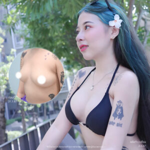 เสริมหน้าอกซัน เสริมหน้าอก เสริมหน้าอกครั้งแรก Motiva mediprimeclinic breast surgery ซันไชน์