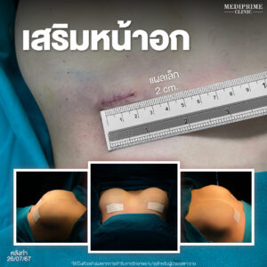 เสริมหน้าอก Mediprime Clinic แก้หน้าอก แผลเล็ก