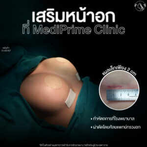 เสริมหน้าอก Mediprime Clinic แก้หน้าอก แผลเล็ก